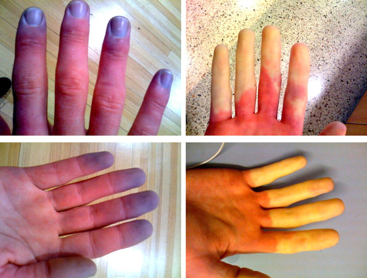 The three color phases of Raynaud's syndrome: white, blue, and red