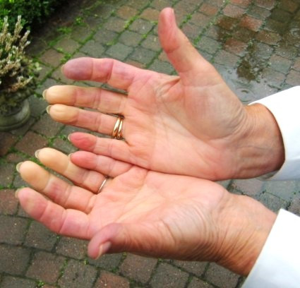 Raynaud's syndrome in menopause showing pale white fingers due to reduced blood flow