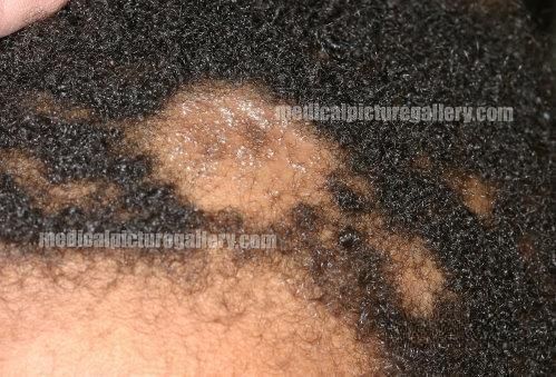 Tinea capitis