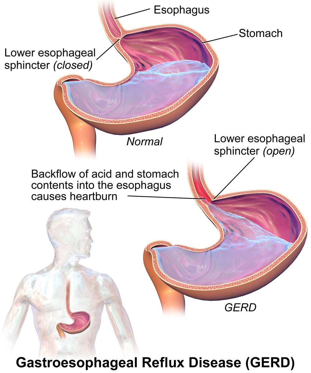 pictogram of acid reflux or GERD