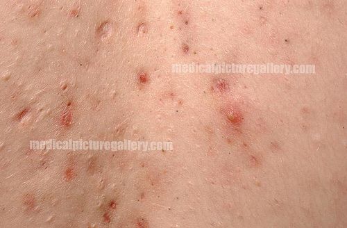 Diseases of the Sebaceous Glands