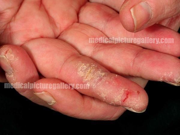 Chronic dermatitis
